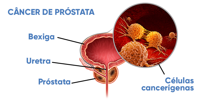 Cancer de prostata o que e